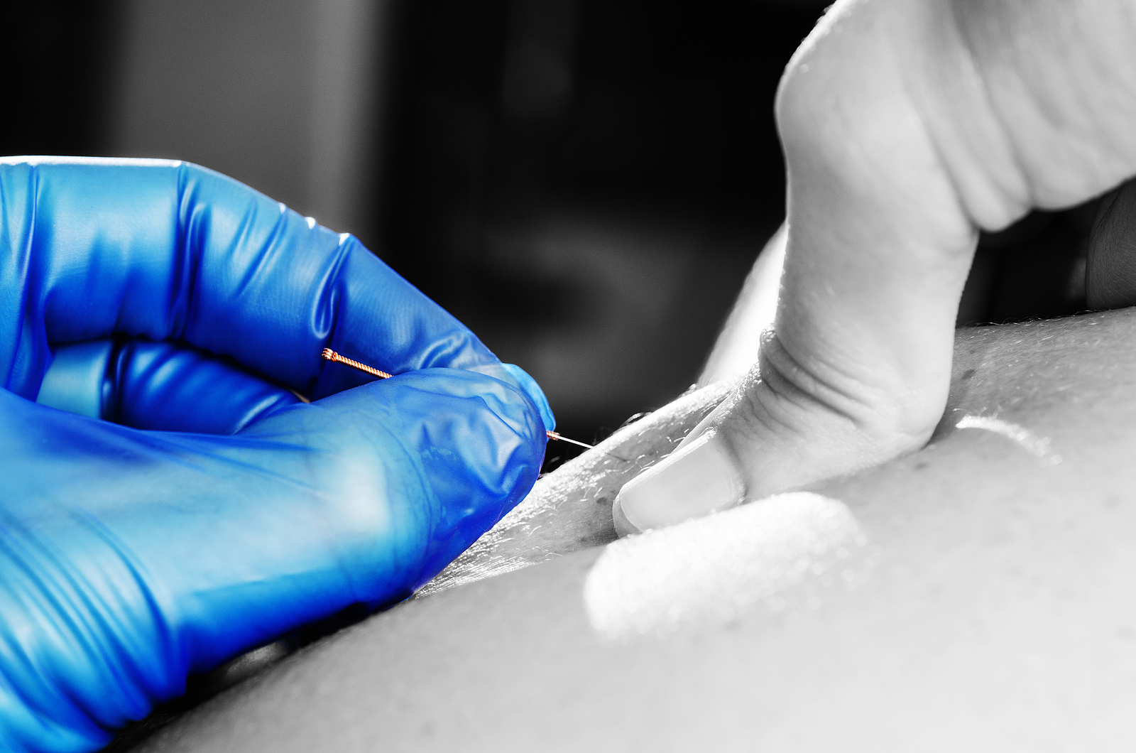 Closeup of a needle and hands of physical therapist doing a dry needling treatment